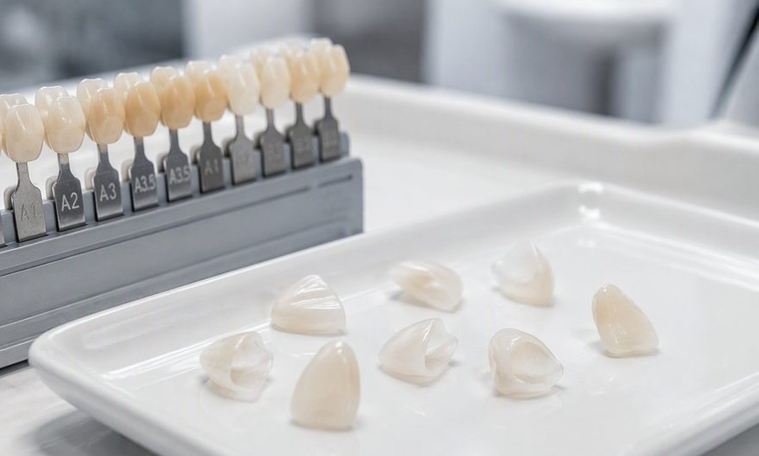 Lâminas de porcelana para facetas dentárias sobre bancada clínica com guia de cores