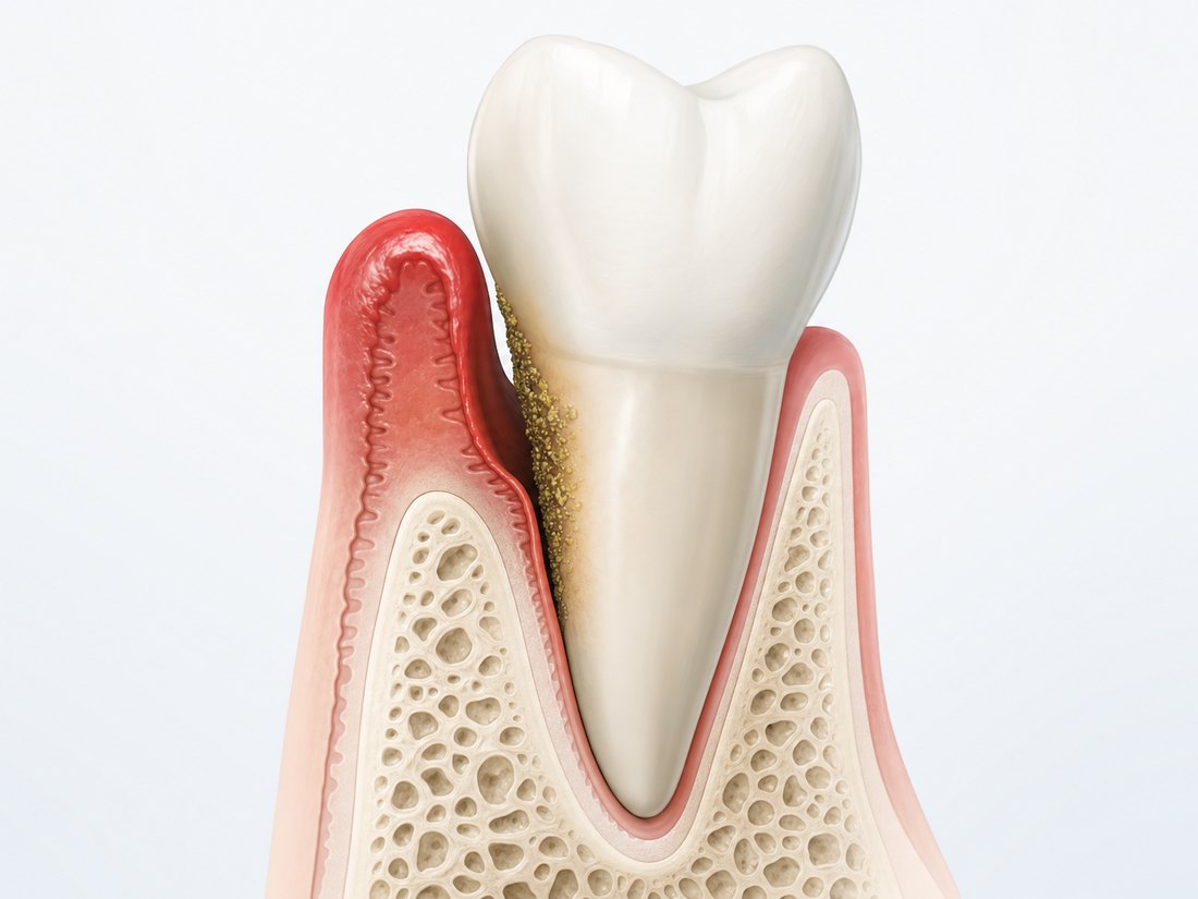 Ilustração em corte da gengiva inflamada ao redor do dente, com a margem gengival avermelhada e acúmulo de biofilme