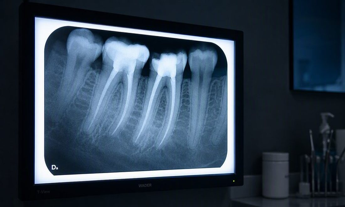 Radiografia periapical de dente com canal tratado em negatoscópio digital