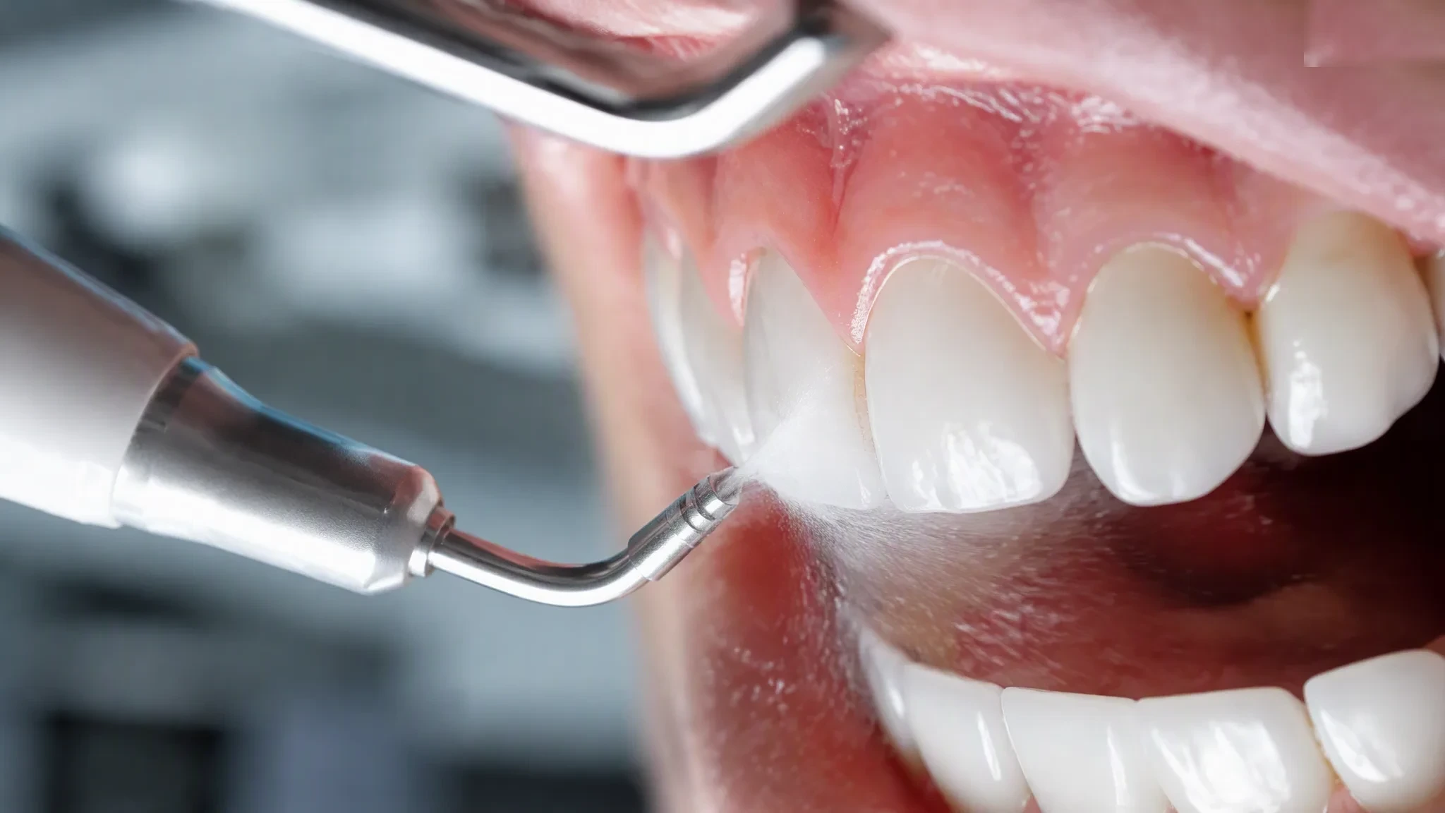 Limpeza dental profissional, um dos pilares do tratamento da halitose