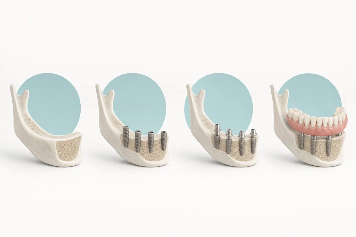 Sequência visual das fases do tratamento com prótese protocolo, do osso sem dentes até a prótese instalada