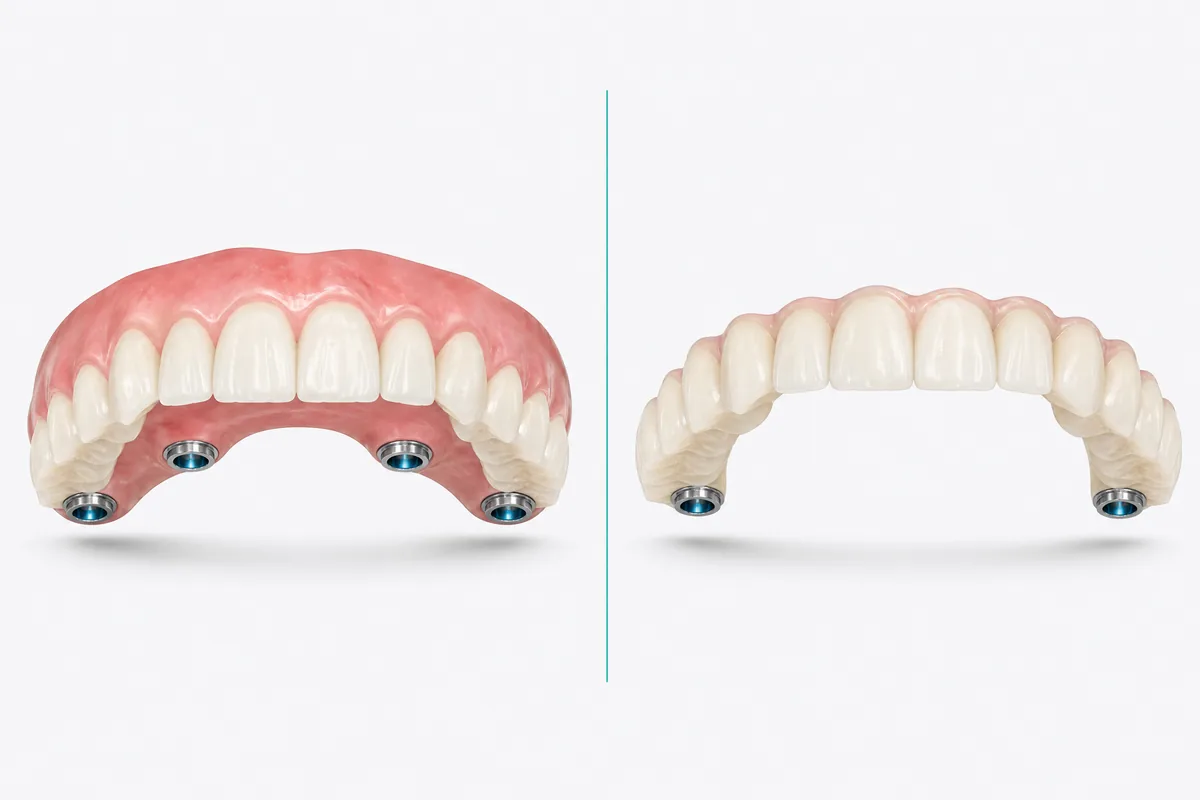 Ilustração de duas próteses protocolo lado a lado: uma com faixa de gengiva artificial rosa e outra sem, apenas com os dentes emergindo da gengiva natural